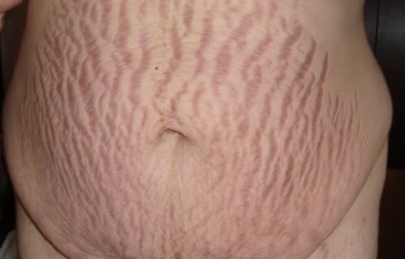 Rạn da sau sinh có chữa được hết hoàn toàn không ?